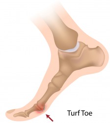 Turf-Toe-224x250